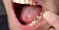 Rotten teeth (Image via Getty Images)